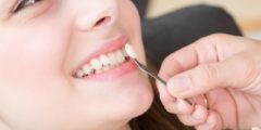 تلبيس الأسنان، وأنواع التيجان المختلفة، وكيفية التركيب