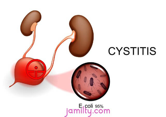 التهابات المثانة ( Cystitis )