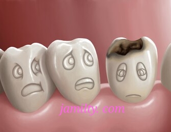 اسنان مسوسة تسبب لك الألم تعرف على أسبابها وطرق العلاج جميلتي