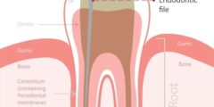 جذور الاسنان تعرف على انواع الالتهابات والمضاعفات المصاحبة