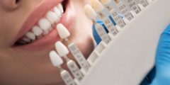 سعر تلبيس الاسنان الأمامية في مصر والولايات المتحدة الأمريكية